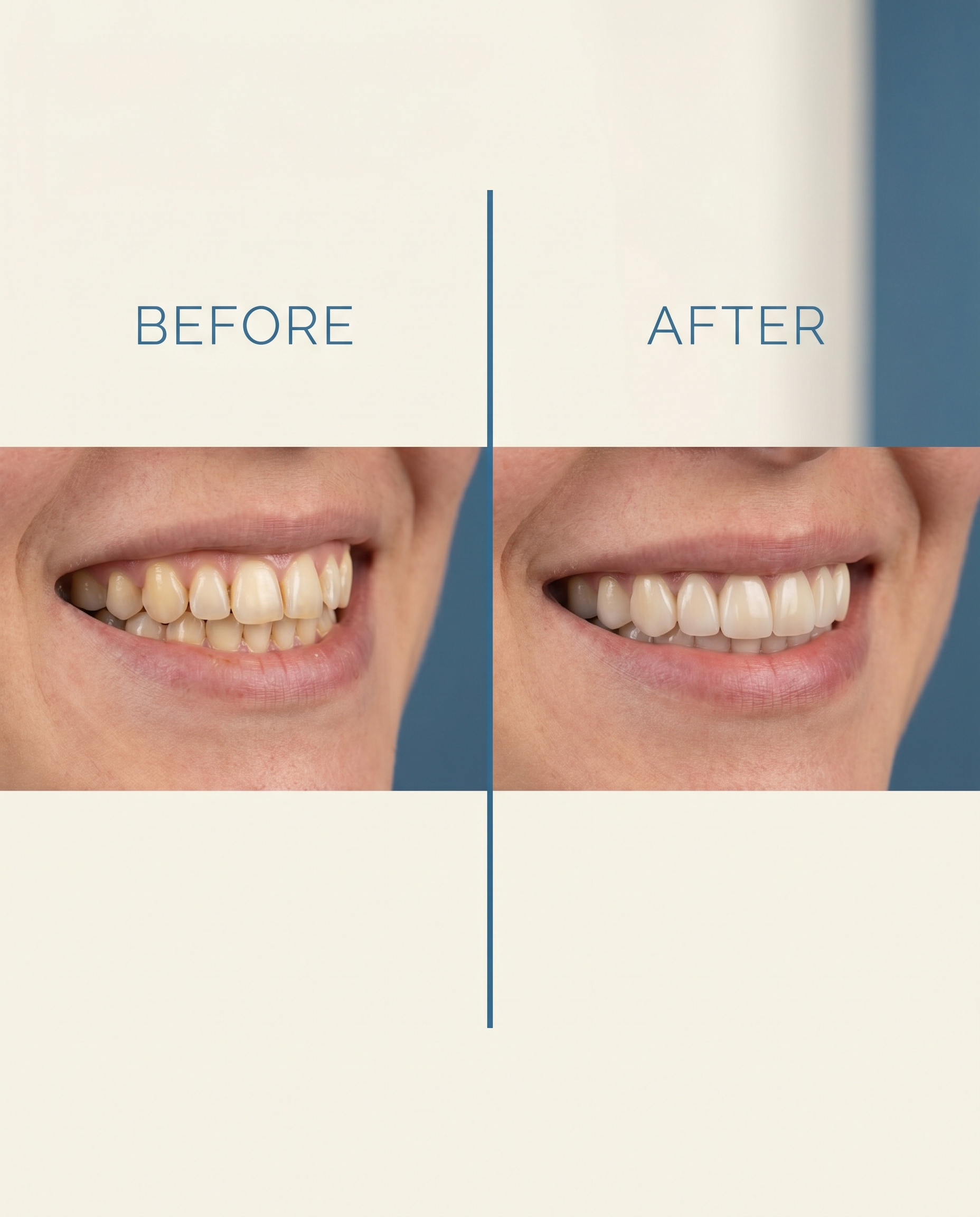 Before and after veneer case