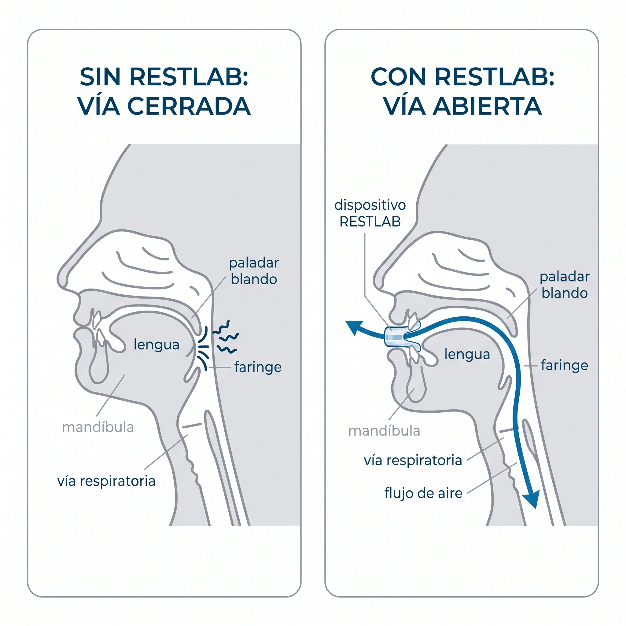 Sin RestLab la mandíbula cae y cierra la vía y aparece la vibración del ronquido; con RestLab la mandíbula queda adelantada y la vía abierta con el aire fluyendo libre