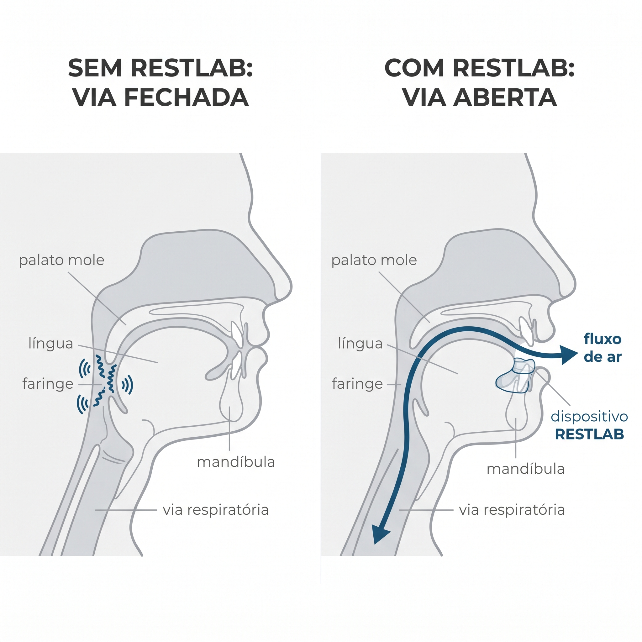 Sem RestLab a mandíbula cai e fecha a via com a vibração do ressonar; com RestLab a mandíbula fica avançada e a via aberta com o ar a fluir livre