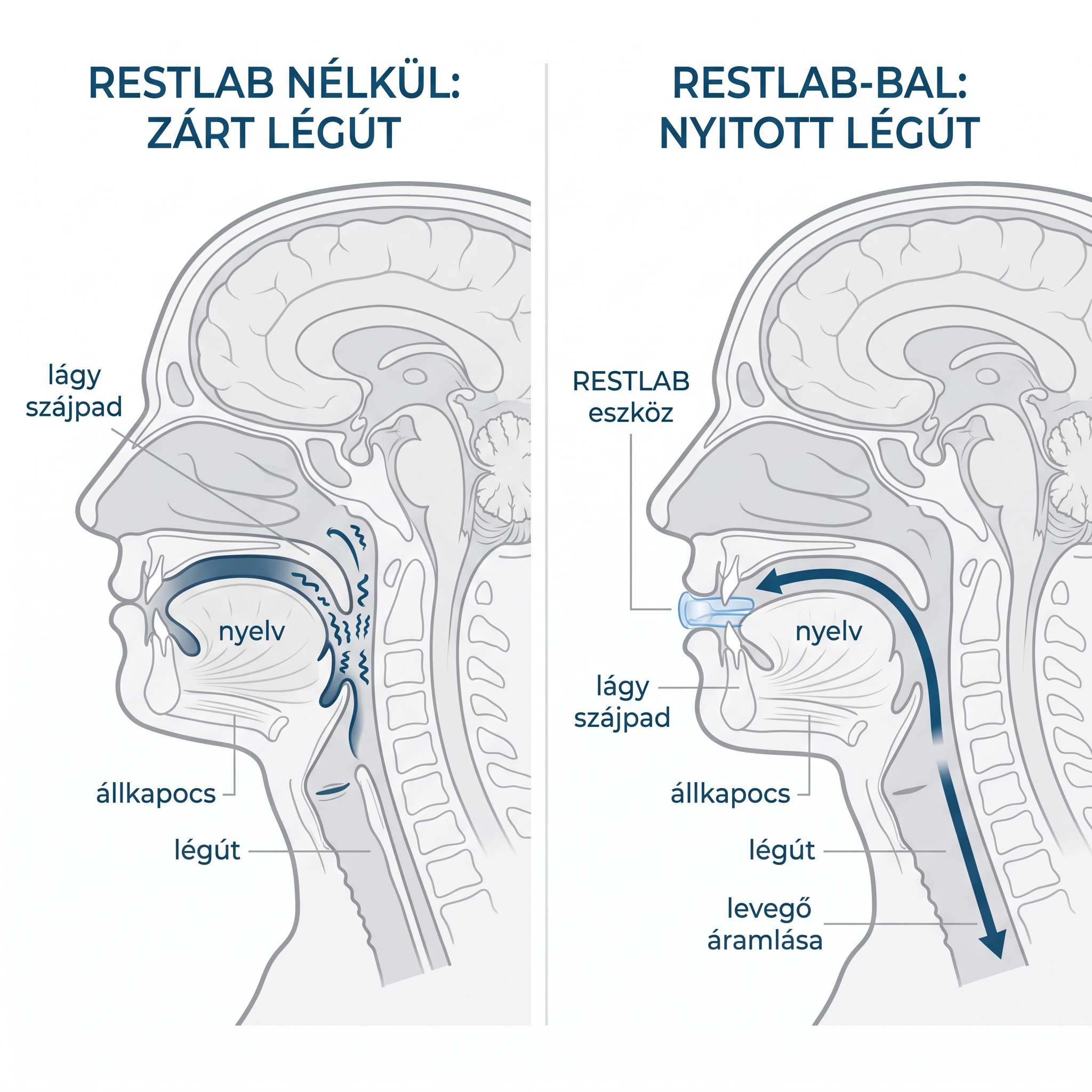 RestLab nélkül az állkapocs leesik és bezárja a légutat a horkolás rezgésével; RestLab-bal az állkapocs előretolva és a légút nyitva, a levegő szabadon áramlik