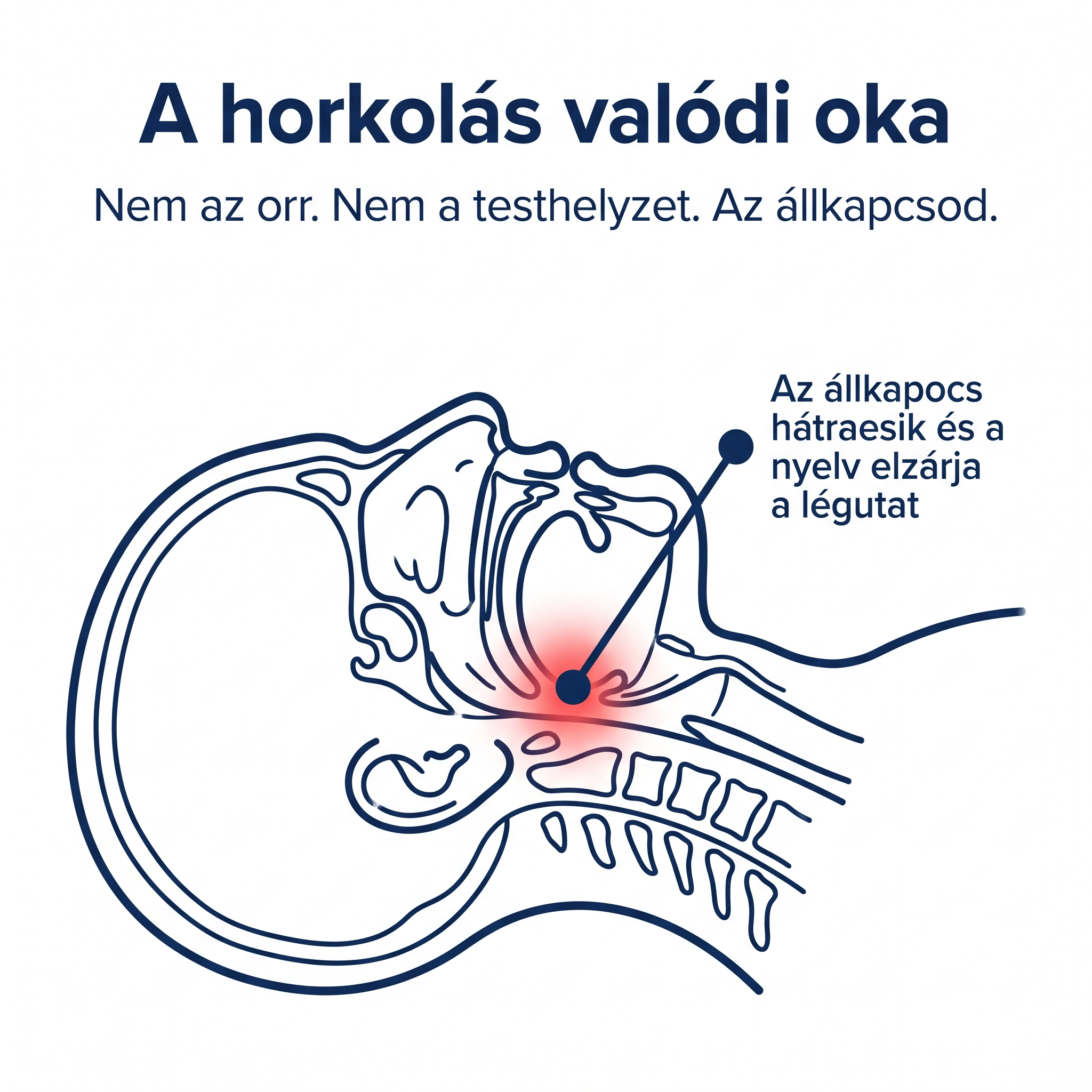 A horkolás valódi oka: az állkapocs hátracsúszik és elzárja a légutat, nem az orr