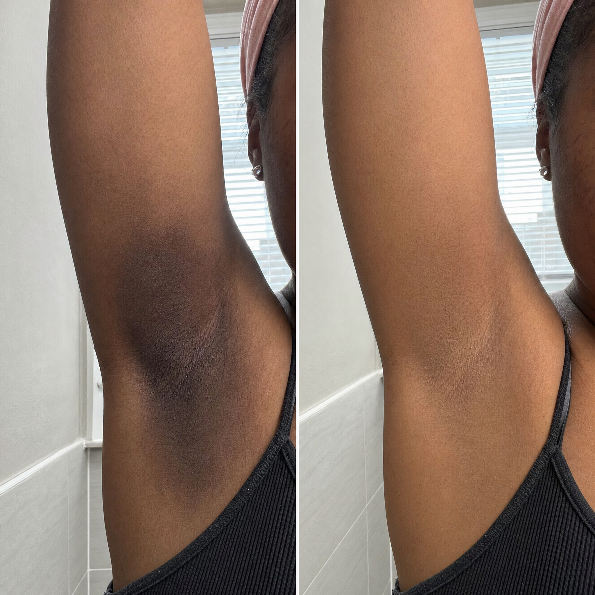 Dark underarms before and after