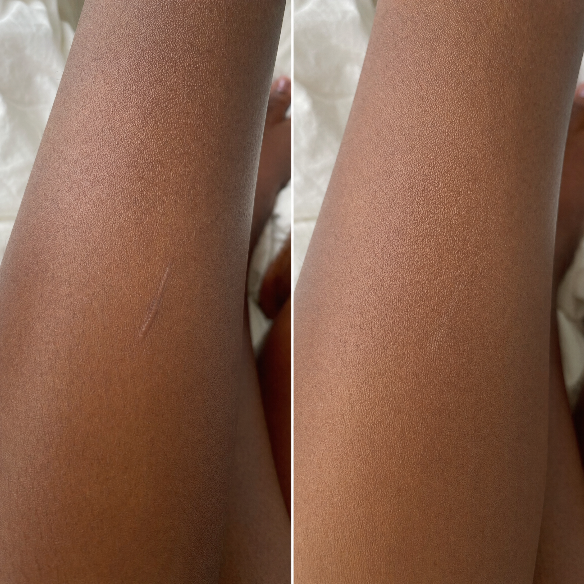 Scars before and after