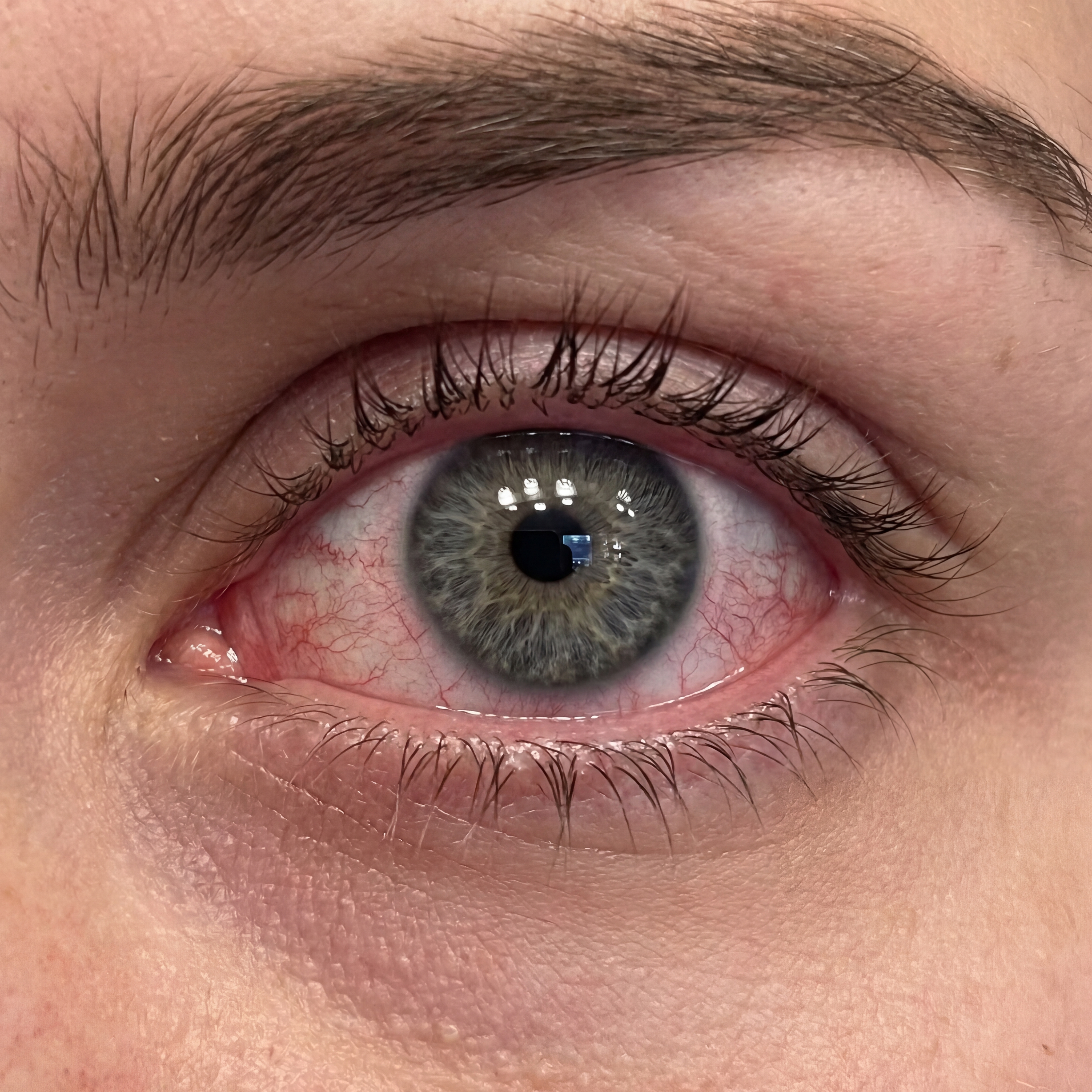 Eye appearance before using Velura Iris