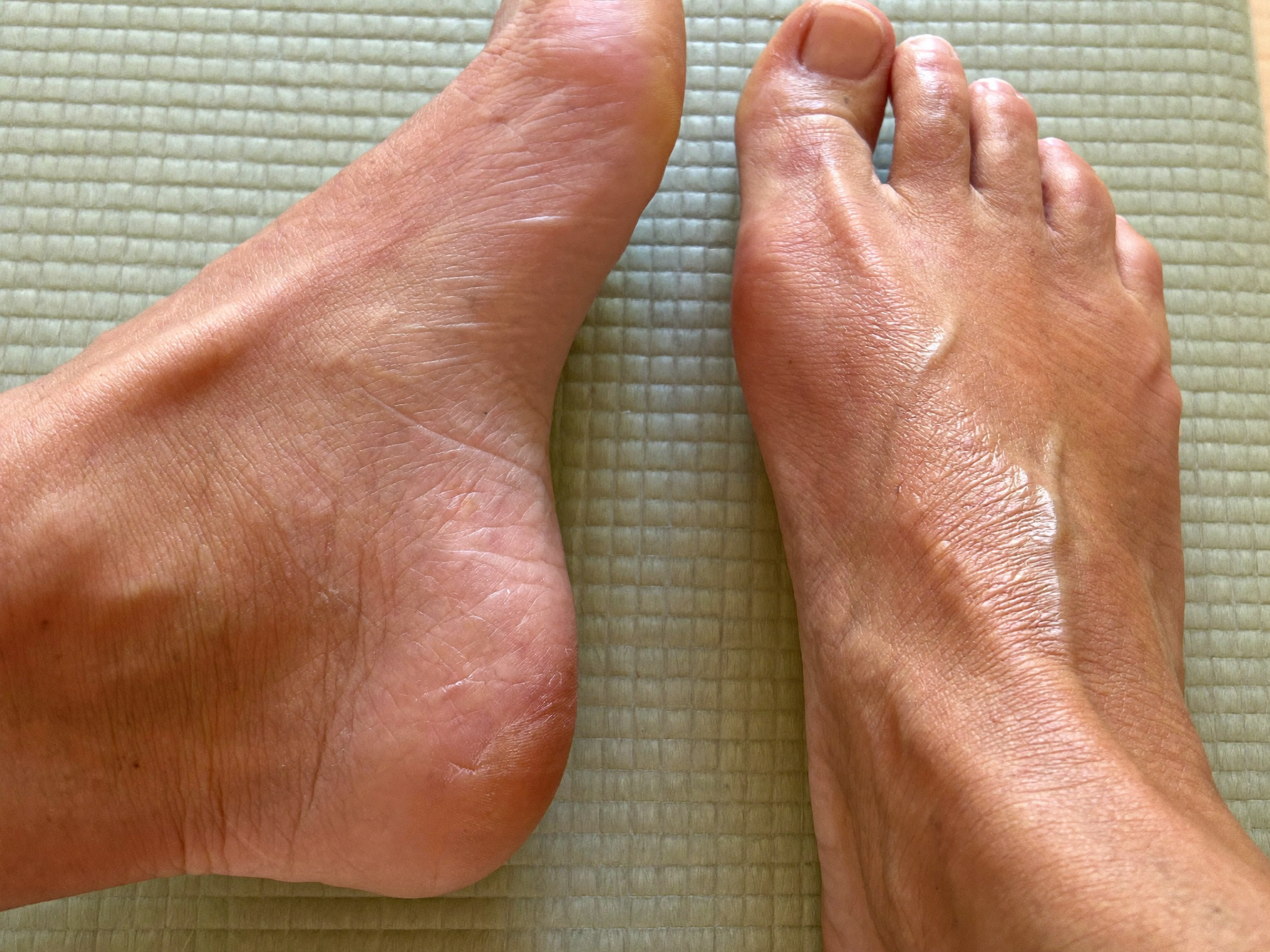 Before and after close-up of a woman's heel showing cracked skin resolved after 4 weeks of TerraFoot