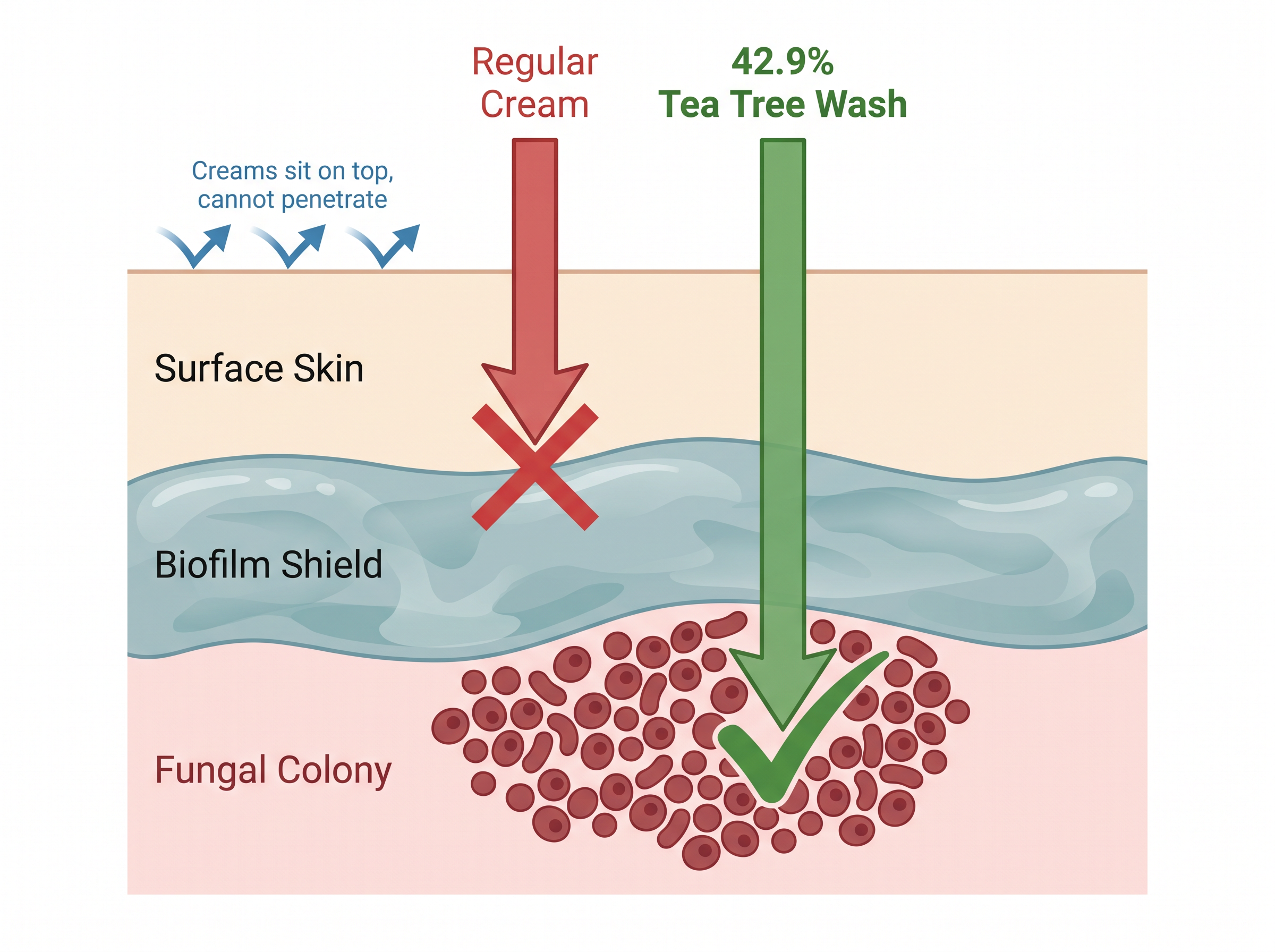 Scientific diagram showing how fungal biofilm shields the colony under the skin surface and why creams cannot penetrate it