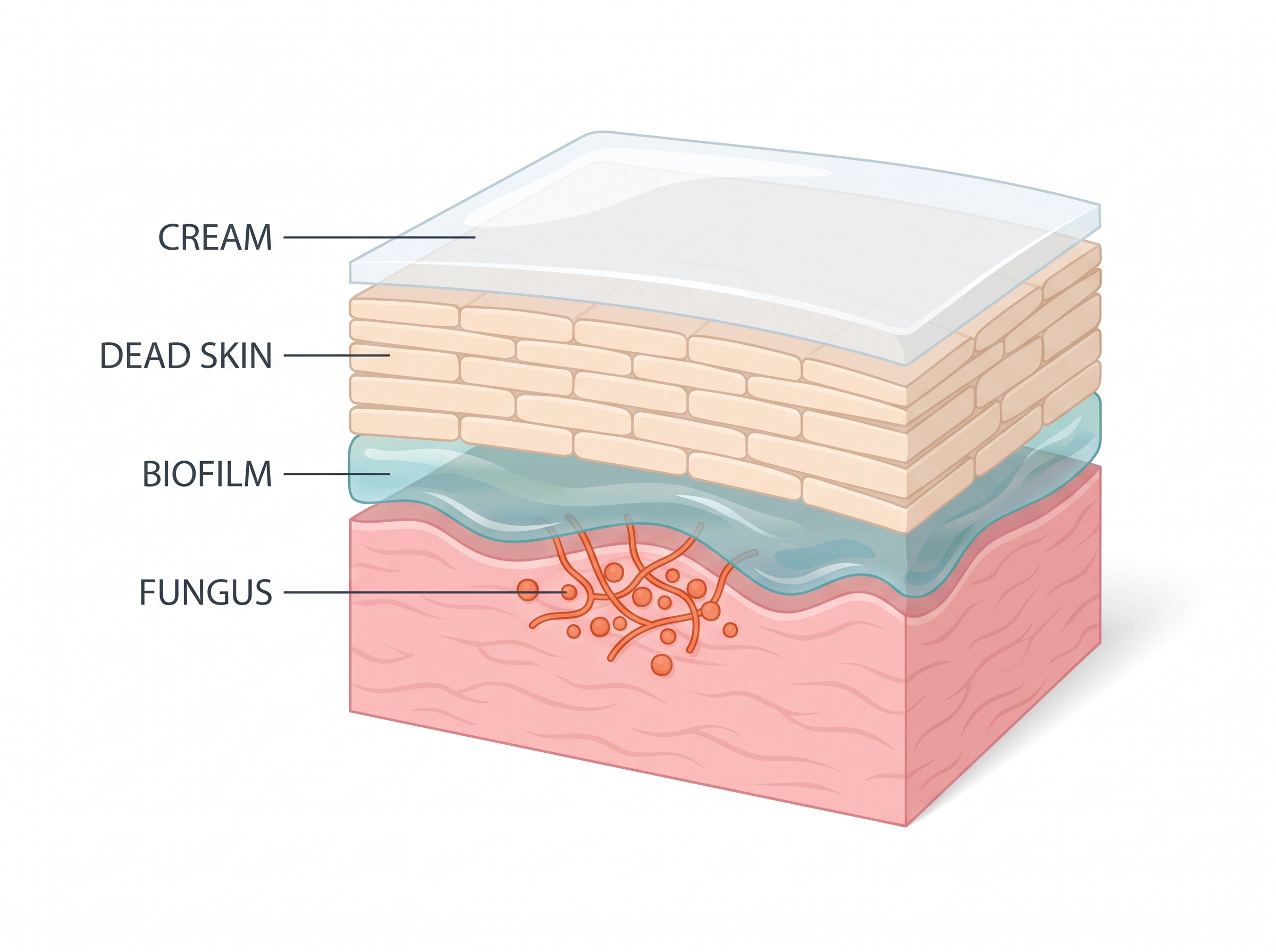 Cross-section of heel skin showing cream on the surface above a shielded layer