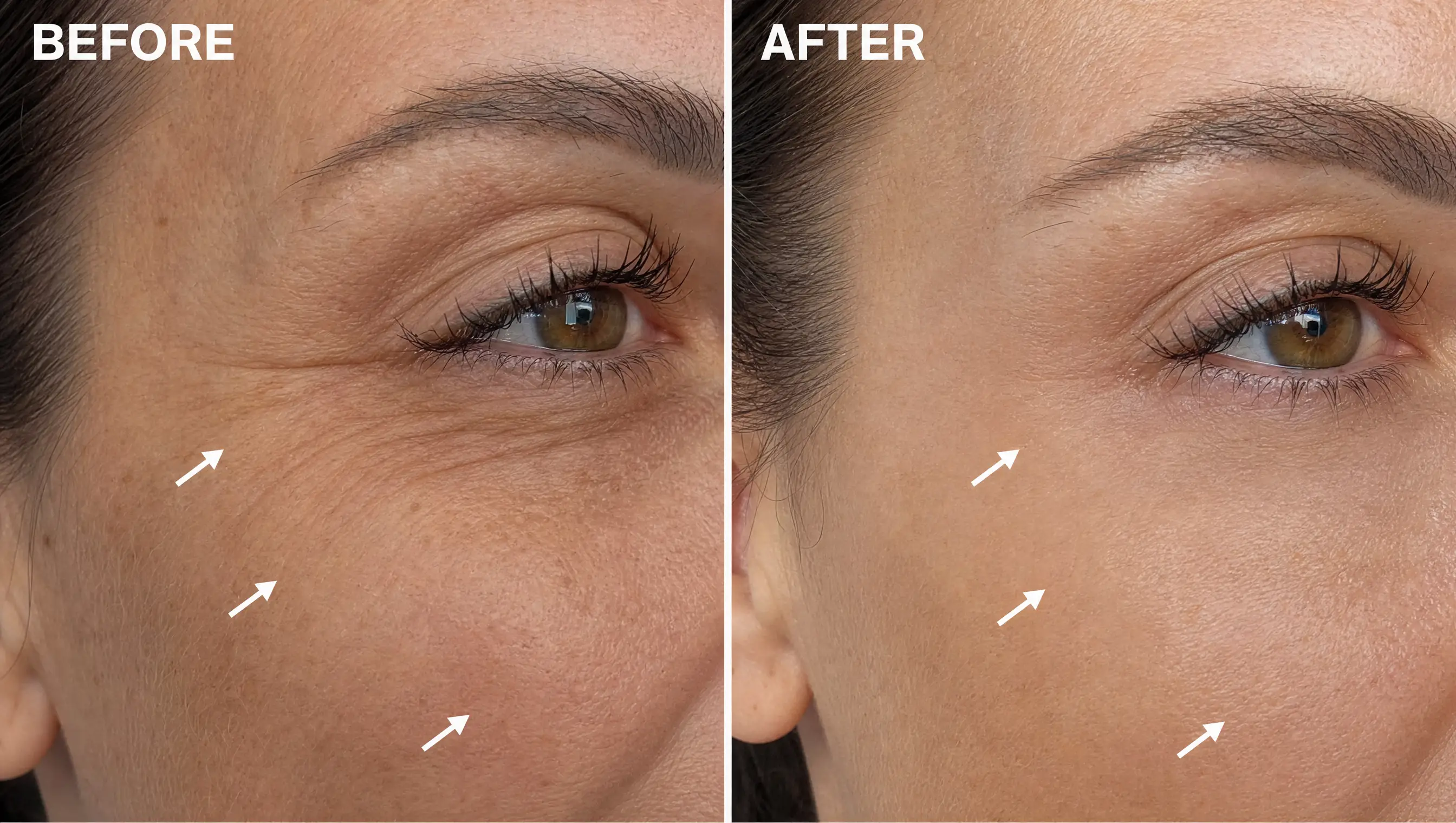 Fine lines before and after