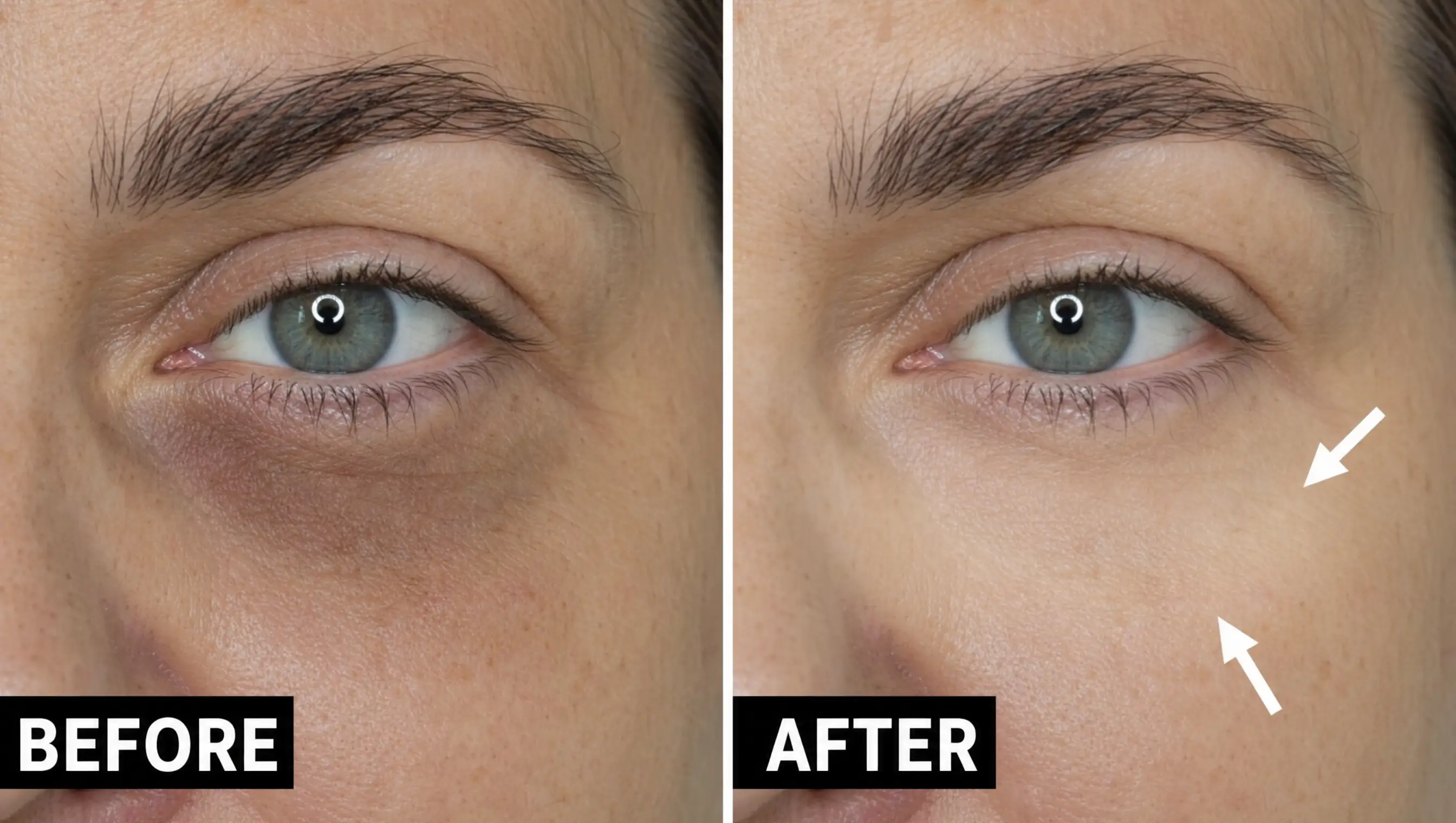 Dark circles before and after