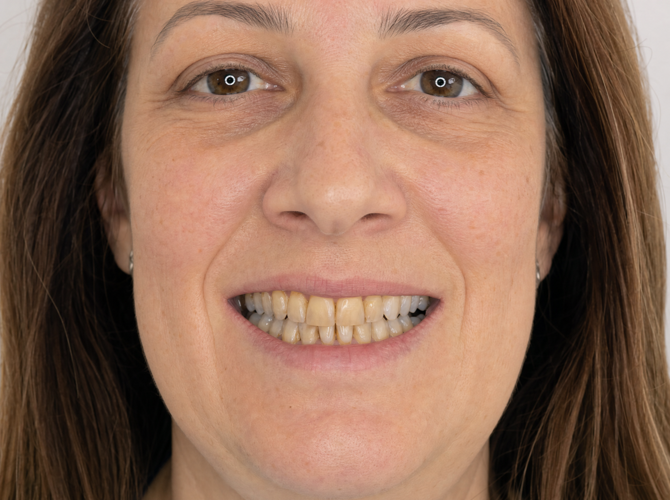 Discolored teeth before professional whitening treatment