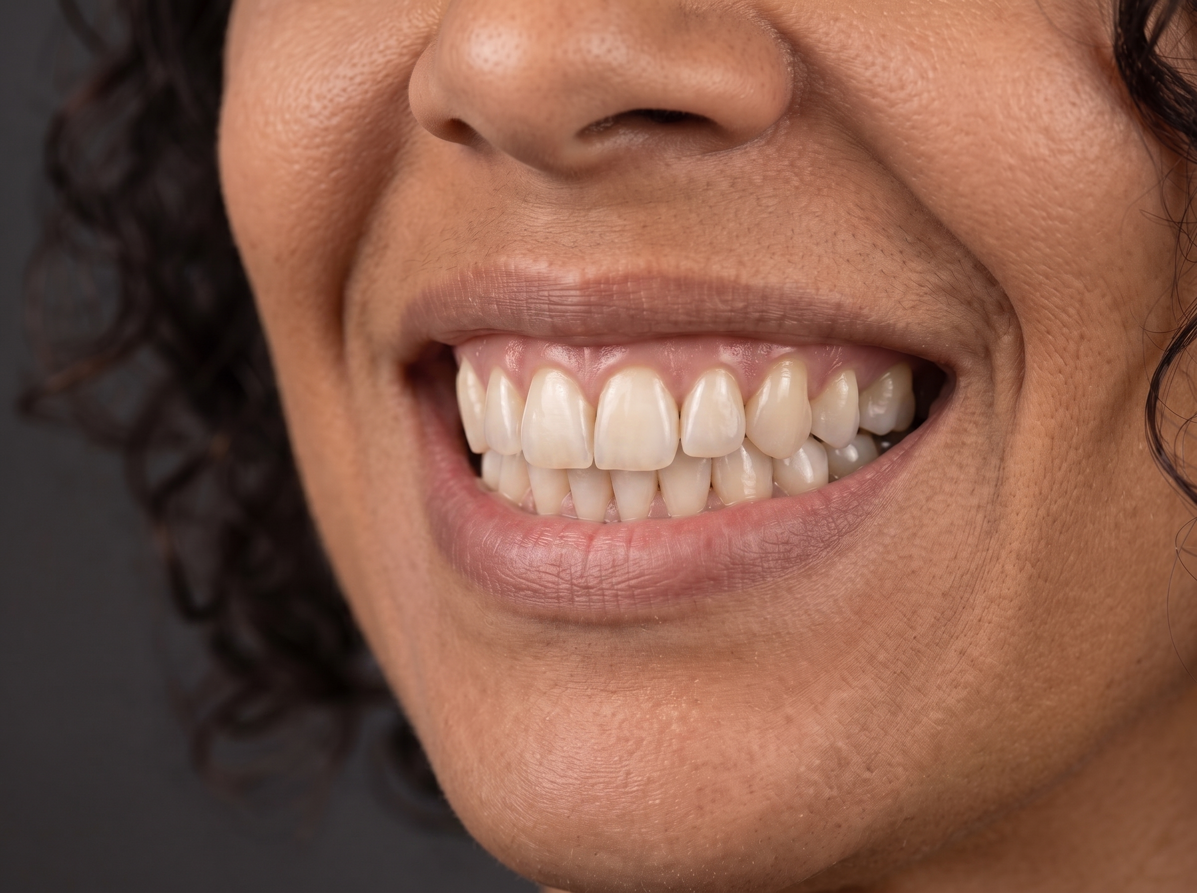 Caso 04 — Clareamento dentário, depois do tratamento