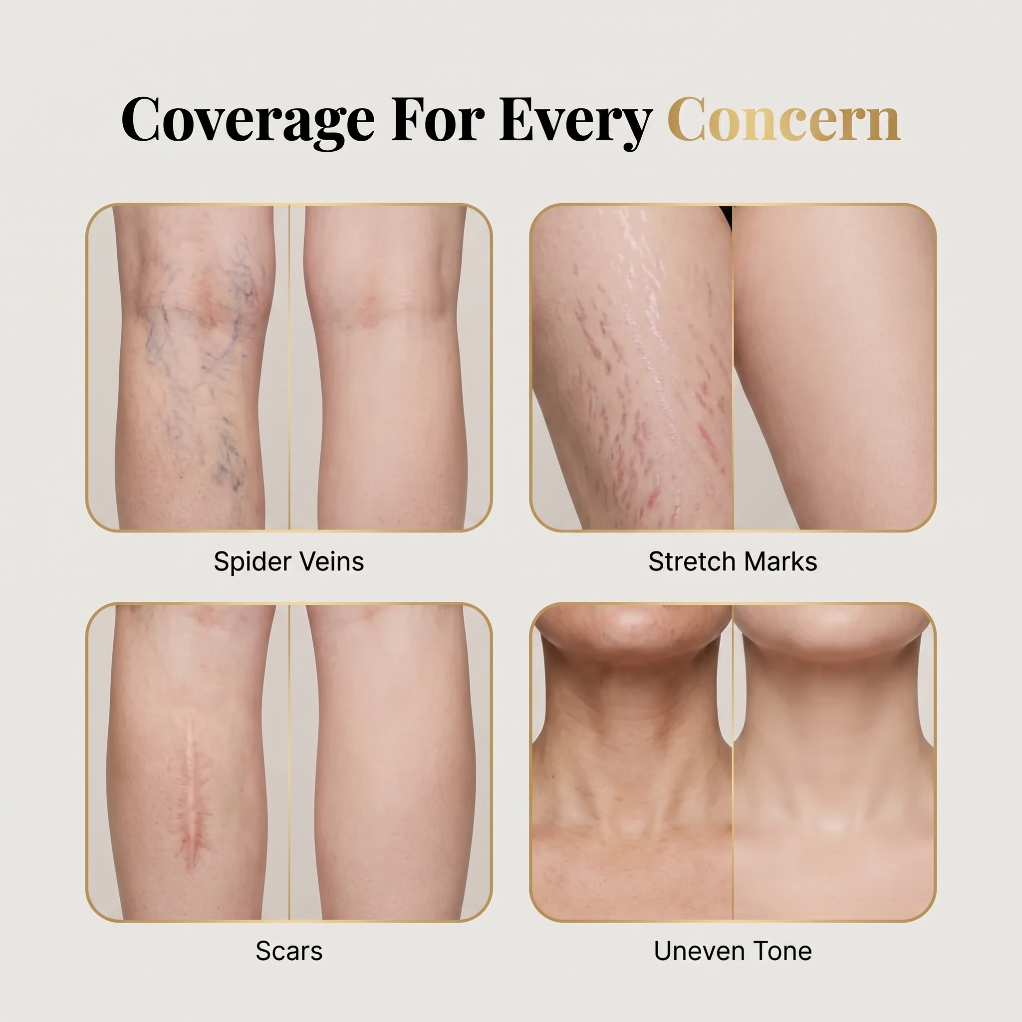 MAEVEN covers spider veins, stretch marks, scars and uneven tone on fair skin