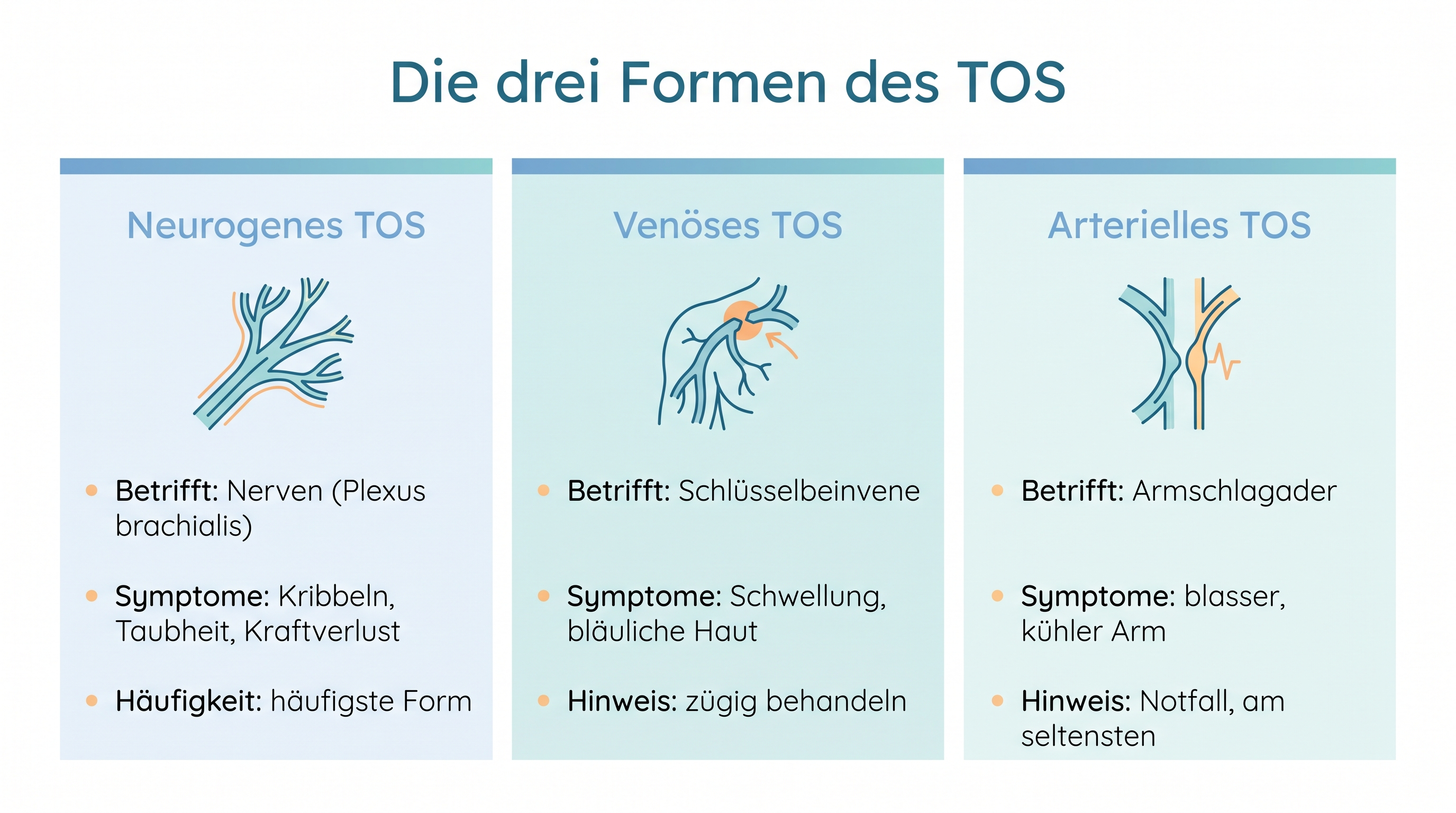 Thoracic Outlet Syndrom (TOS): Das Rätsel hinter dem eingeschlafenen Arm 6 Infografik der drei Formen des Thoracic Outlet Syndroms – neurogen, venös und arteriell im Vergleich