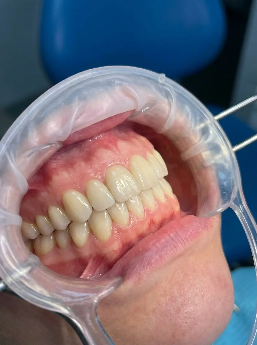 Intraoral result of VDO rehabilitation