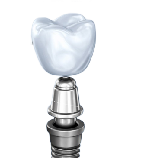 3D dental implant and crown