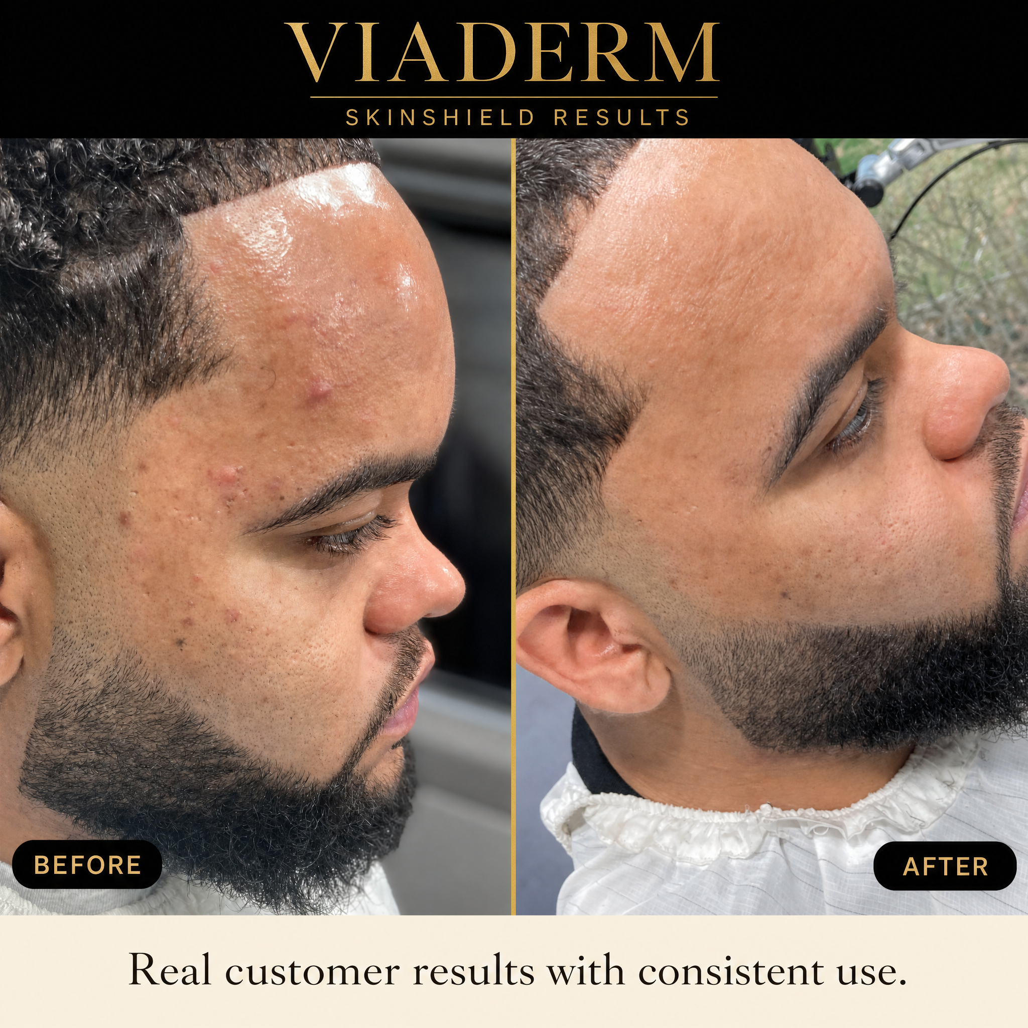Before and after results using VIADERM SkinShield
