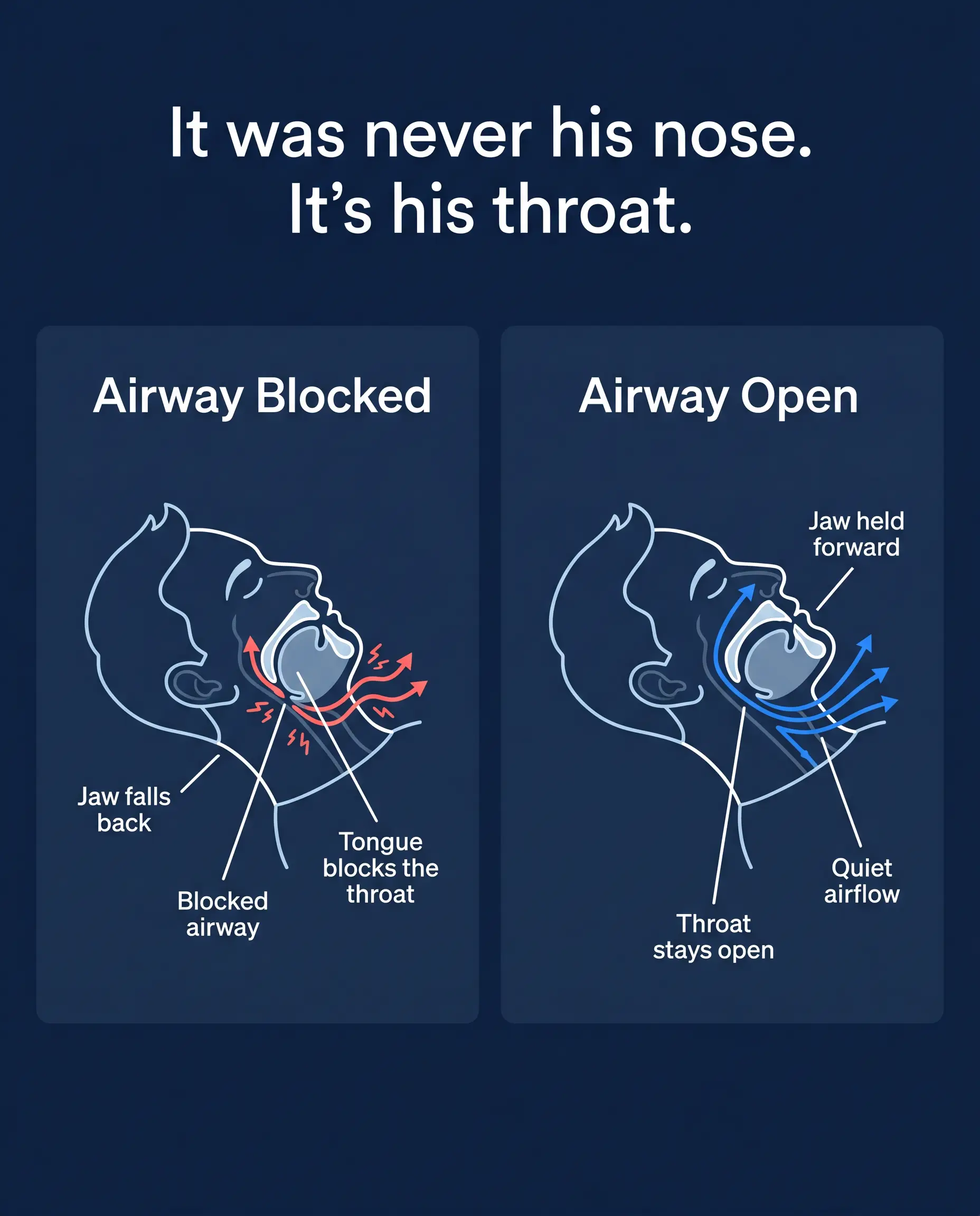 Diagram: airway blocked when the jaw relaxes back versus open airway when the jaw is held forward
