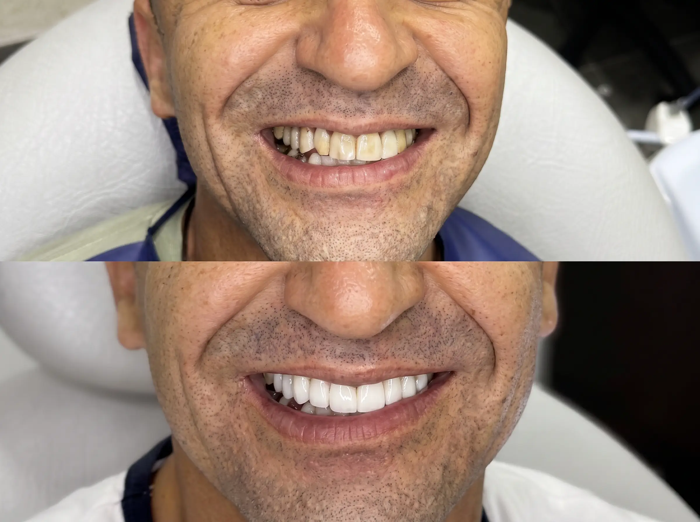 Antes y después de carillas en cerámica
