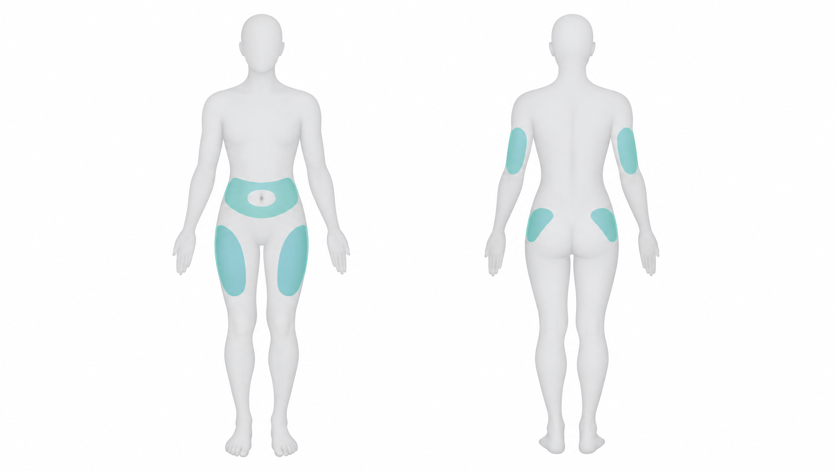 Diagram of subcutaneous injection sites on the front and back of the body: abdomen, front and outer thigh, back of the upper arm and upper outer buttock