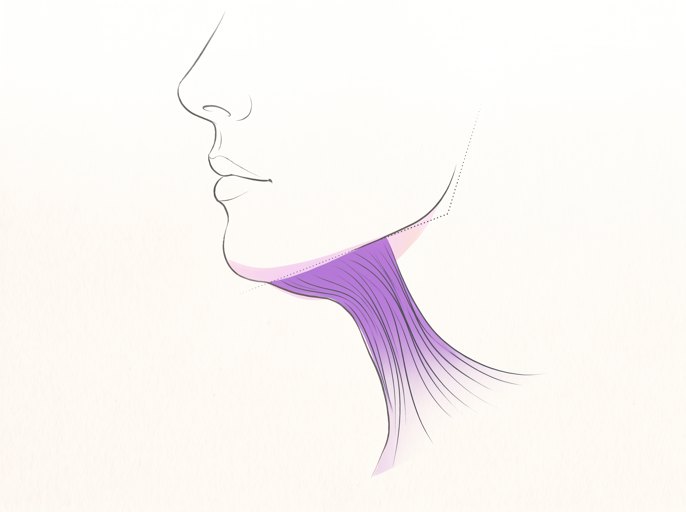 턱 밑 피하지방층과 그 아래 늘어진 광경근을 보여주는 옆얼굴 해부 일러스트